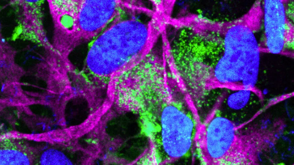 Med infärgning visas de skadliga aggregaten och hur alfa-synuklein (grönt) ansamlas i astrocyterna (lila). Cellkärnorna färgas blå. Bild: Laurent Roybon. 