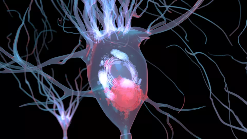 Datoranimerad bild som visar en Lewykropp inuti hjärnan. Lewykroppen är ballongliknande i sin form, blå-röd och innehåller mindre molekyler. Ut från lewykroppen springer långa trådar. 