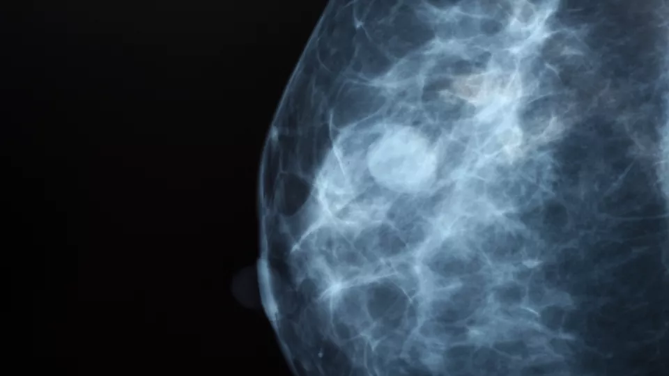 röntgenbild på bröst med cancer. foto.
