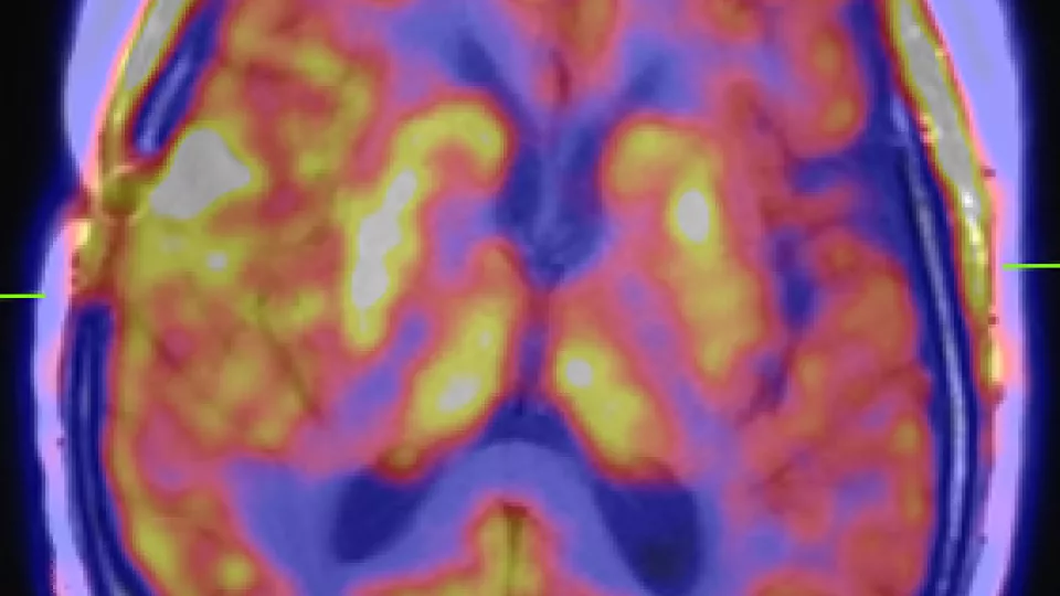 En kombinerad PET-MR-bild av en patient med hjärntumör - dock tagen med dagens teknik och inte med den kommande, samtidiga tekniken