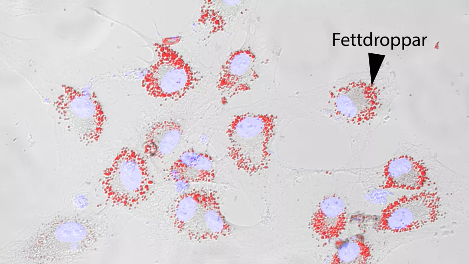 Cellbilderna föreställer cancerceller där cellkärnorna färgats med ljusblått och fettdropparna i rött. 