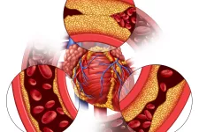 illustration av blodkärl med plack. David Erlinge och forskarkollegor visar att en ny undersökningsmetod vid hjärtsjukdom kan identifiera fettrik plack i blodkärlen som inte går att se med traditionell kranskärlsröntgen. Illustration.