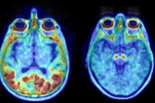 I en klinisk studie har forskare funnit att det sjukdomsalstrande proteinet tau ansamlas fortare hos kvinnor än hos män. Till vänster visas patologiskt upptag av hur proteinet tau  i hjärnan (rött). Till höger frisk hjärna. Bild.