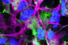 Med infärgning visas de skadliga aggregaten och hur alfa-synuklein (grönt) ansamlas i astrocyterna (lila). Cellkärnorna färgas blå. Bild: Laurent Roybon. 