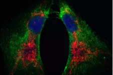 Bilden är tagen i mikroskop och föreställer bröstcancerceller som uttrycker en stamcellsmarkör (i grönt) och ett tätt sammanvuxet mitokondrielt nätverk (i rött). Foto.