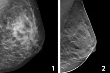 Mammografi görs med en speciell röntgenapparat där strålningsmängden är liten (bild 1). Brösttomosyntes är en typ av 3D-mammografi som ger en mer detaljerad bild av bröstet än vanlig mammografi (bild 2). Foto.