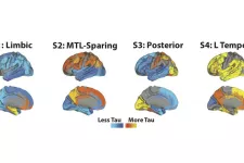 Bild på spridningen av proteinet tau i hjärnan vid alzheimer som enligt en ny studie varierar enligt fyra distinkt mönster. Foto.