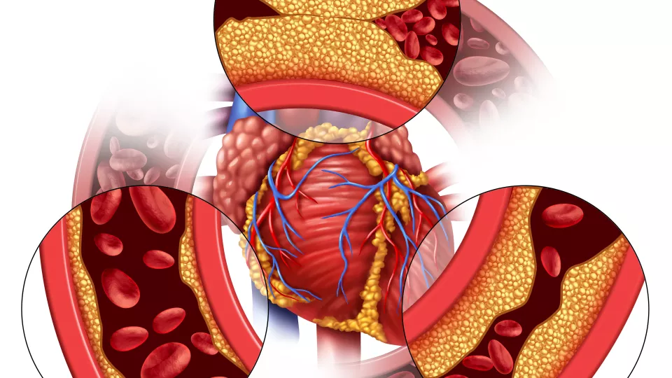 illustration av blodkärl med plack. David Erlinge och forskarkollegor visar att en ny undersökningsmetod vid hjärtsjukdom kan identifiera fettrik plack i blodkärlen som inte går att se med traditionell kranskärlsröntgen. Illustration.
