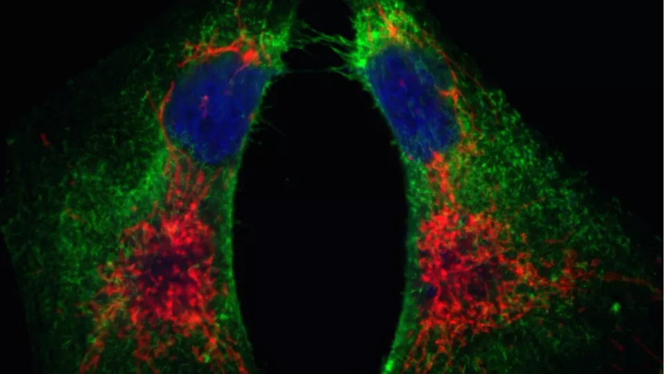 Bilden är tagen i mikroskop och föreställer bröstcancerceller som uttrycker en stamcellsmarkör (i grönt) och ett tätt sammanvuxet mitokondrielt nätverk (i rött). Foto.
