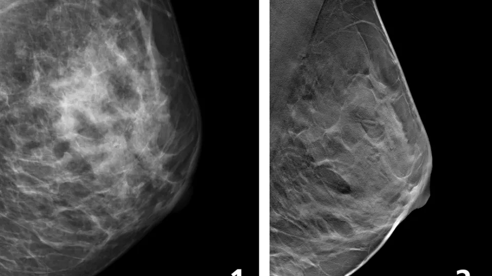 Mammografi görs med en speciell röntgenapparat där strålningsmängden är liten (bild 1). Brösttomosyntes är en typ av 3D-mammografi som ger en mer detaljerad bild av bröstet än vanlig mammografi (bild 2). Foto.