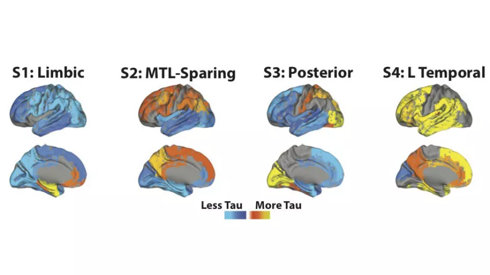 Bild på spridningen av proteinet tau i hjärnan vid alzheimer som enligt en ny studie varierar enligt fyra distinkt mönster. Foto.