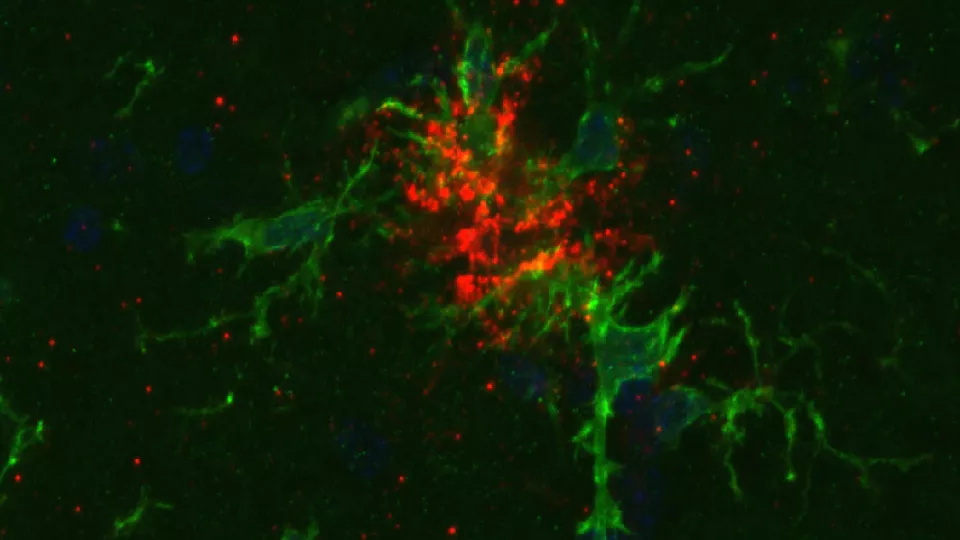 bild på hjärnans mikrogliaceller (grönt) har förmågan att plocka upp klumparna av beta-amyloid (rött) som ansamlas vid Alzheimers sjukdom. ECT verkar inte försämra denna process, visar forskare i ny studie. Foto.