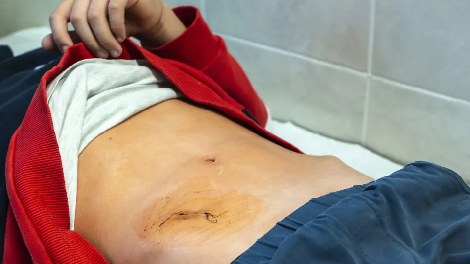 Forskare har undersökt om ökad stress - mätt som kortisolkoncentrationer i hår - påverkar risken för blindtarmsinflammation och risk för komplicerat sjukdomsförlopp. Studien är gjord på barn under 15 år. Foto.