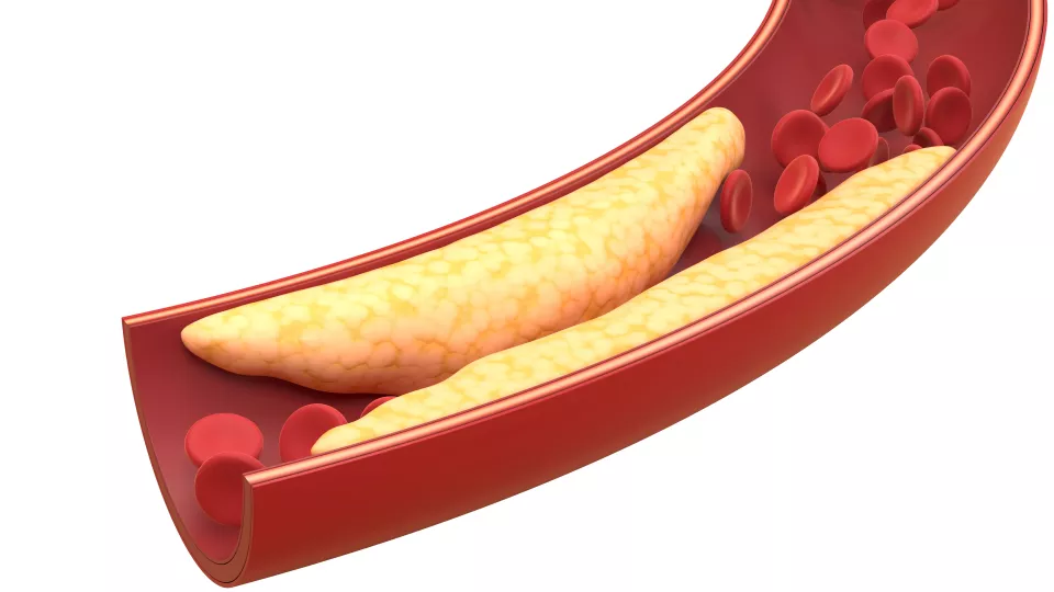 Bild på örträngning i blodkärl. Forskare vid Skånes universitetssjukhus och Lunds universitet, har i en ny studie tillsammans med forskarkollegor studerat patienter som sedan födseln lider av förträngning av aorta. Bild.