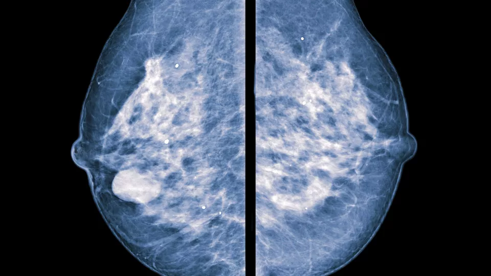 röntgenbild av bröstcancer. foto.