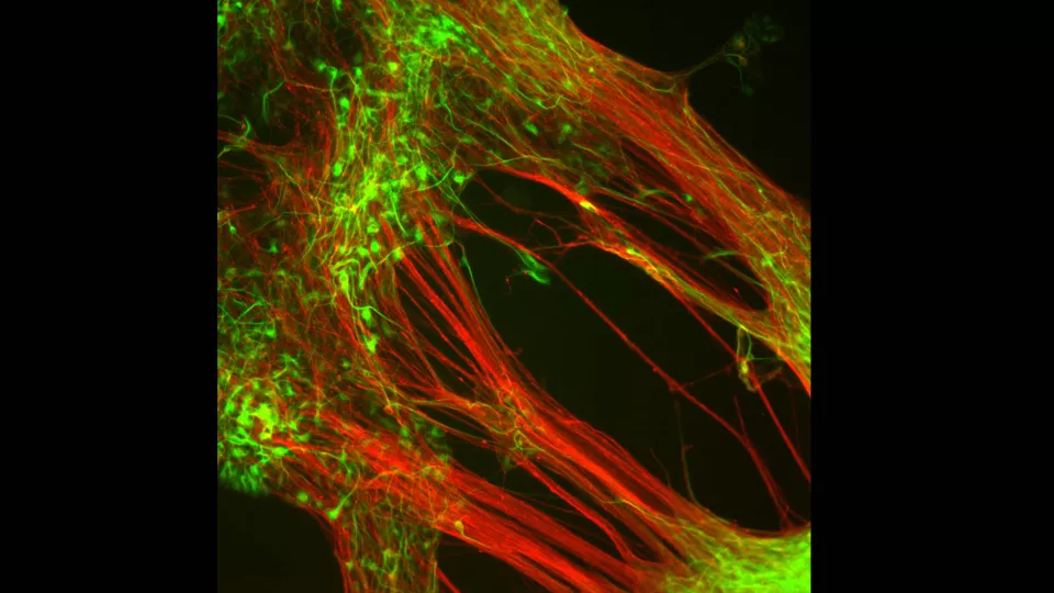 Dopaminproducerande nervceller som forskare från Lunds universitet odlat fram i laboratorium från humana embryonala stamceller. Foto.
