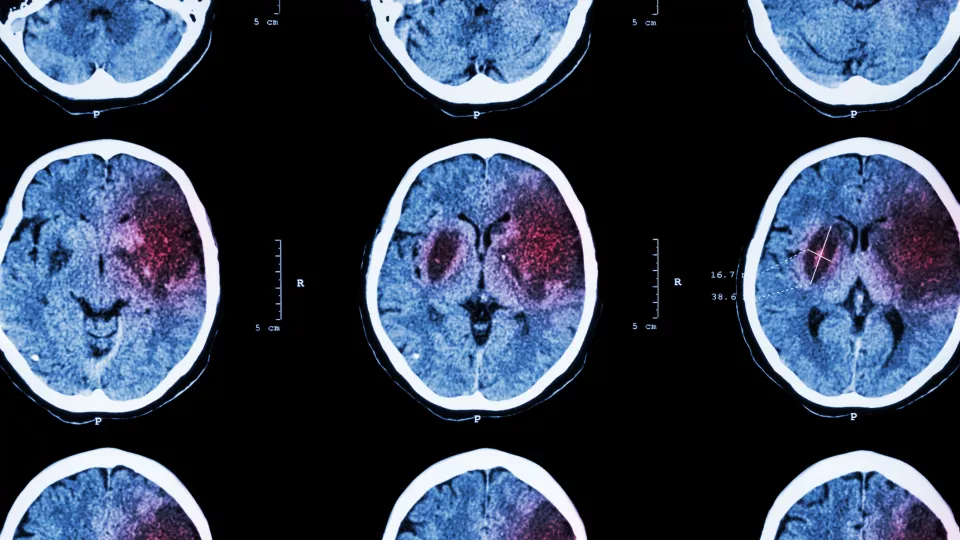 röntgenbild av hjärna med stroke. foto.
