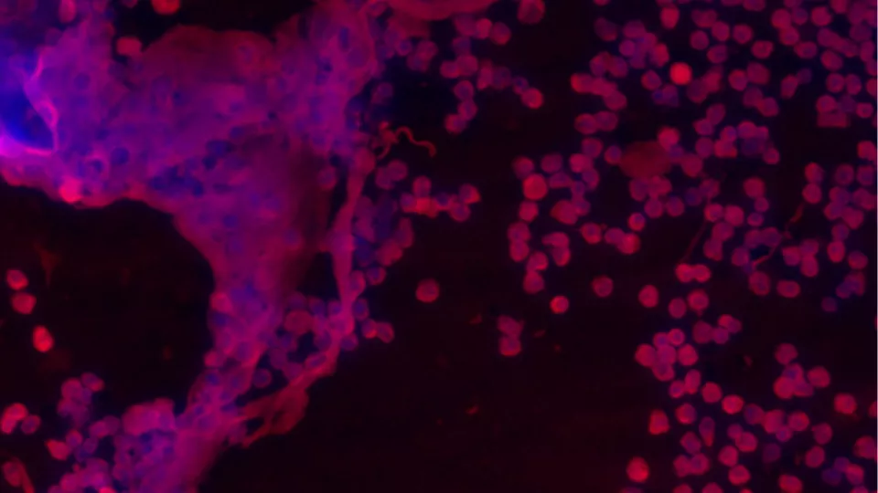 På bilden syns vita blodceller (neutrofiler) i ryggmärgsvätskan vid bakteriell meningit