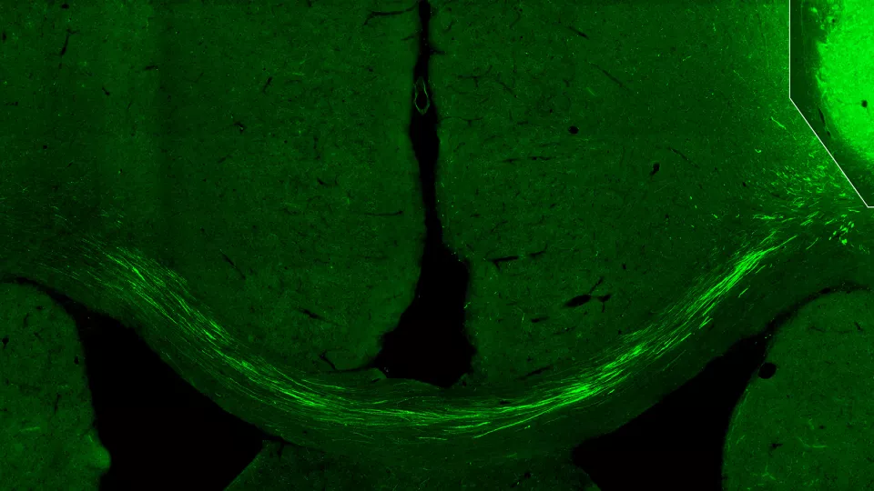 Transplanterade nervceller (transplantat uppe till höger) som tillverkats från mänskliga hudceller skickar sina nervtrådar till hjärnbarken på motsatta sidan i hjärnan. Bildkälla: Zaal Kokaia