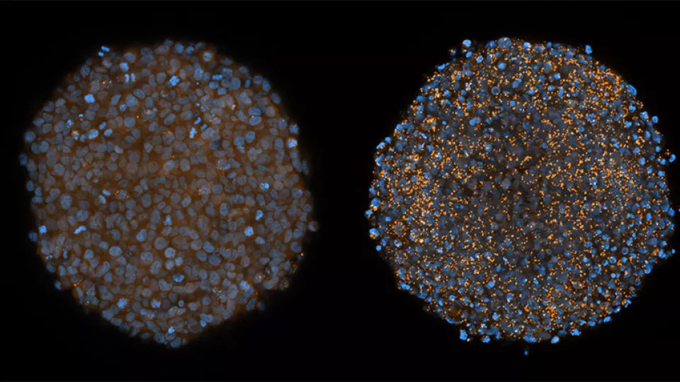 bild: Forskarna odlade små tumörer av celler från livmoderhalscancer i provrör, så kallade tumörfäroider. Den högra har behandlats med klorokin, vilket orsakat utbredda membranskador (prickar i orange). Det blåa är tumörcellernas kärnor. Bild: Hampus Du R