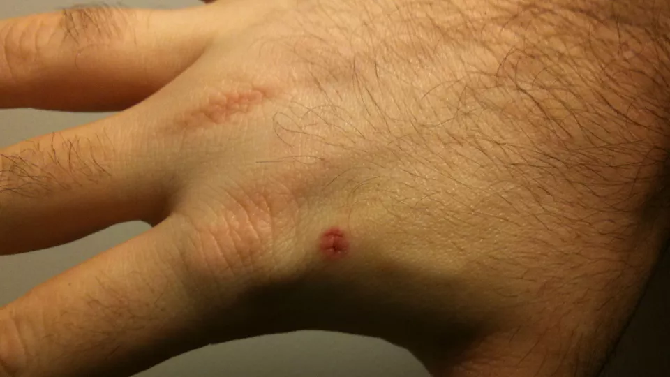 En hand med ett mikrochip inopererat