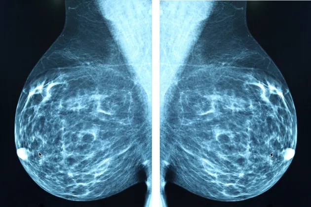 Screeningbild av bröst. Foto: iStock