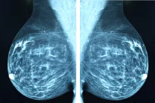 Mammografibild. Foto: iStock