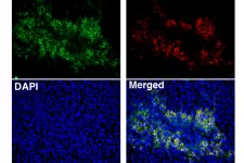 bild på Immunofluoroscence-analys av en melanomtumör som visar att B-celler i B-cellskluster uttrycker CXCR5, som är en markör för tertiära lymfoida strukturer.