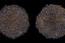 bild: Forskarna odlade små tumörer av celler från livmoderhalscancer i provrör, så kallade tumörfäroider. Den högra har behandlats med klorokin, vilket orsakat utbredda membranskador (prickar i orange). Det blåa är tumörcellernas kärnor. Bild: Hampus Du R