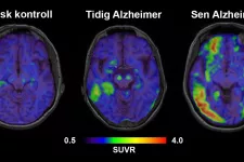 Proteinerna beta-amyloid och tau har betydelse för utvecklingen av Alzheimers sjukdom. Forskare har studerat hur proteinerna förändras över tid i hjärnan. Bildkälla: Niklas Mattsson-Carlgren