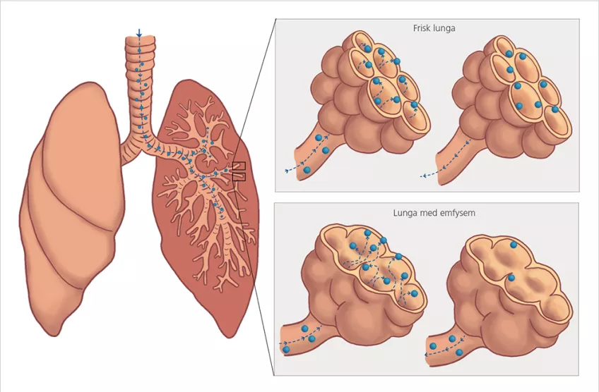 Illustration av hur nanopartiklar rör sig i lungan vid mätning.
