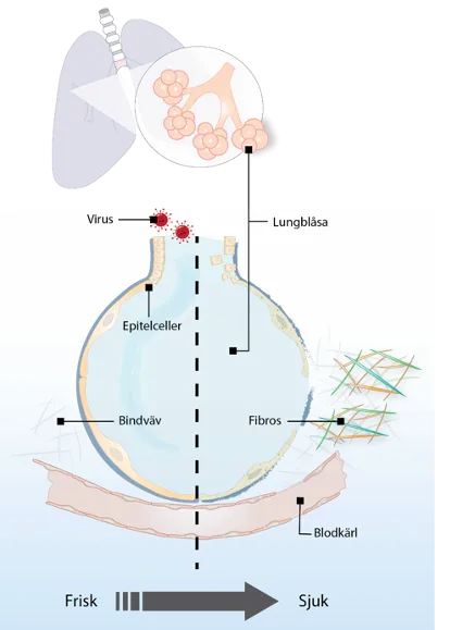 En schematisk bild av en lunga som visar hur de förändras som följd av covid-19 infektion.