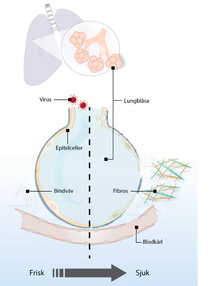 En schematisk bild av en lunga som visar hur de förändras som följd av covid-19 infektion.